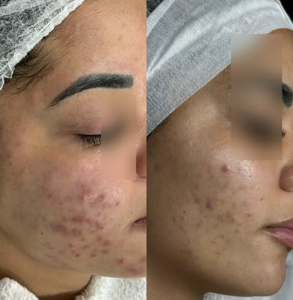 Antes e depois de tratamento para acne inflamatória