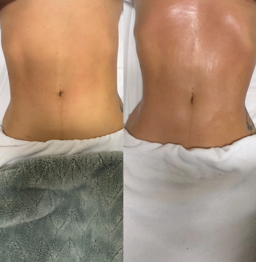 Antes e depois de tratamento corporal na região abdominal - Drenagem Linfática