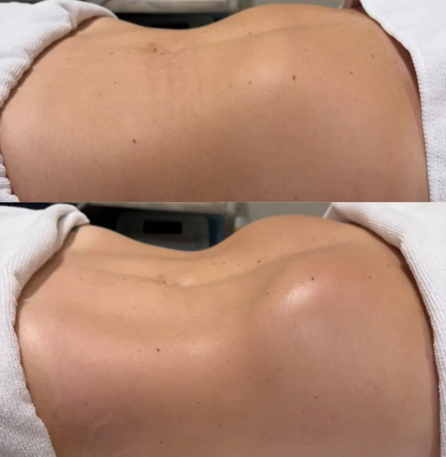Antes e depois de drenagem linfática