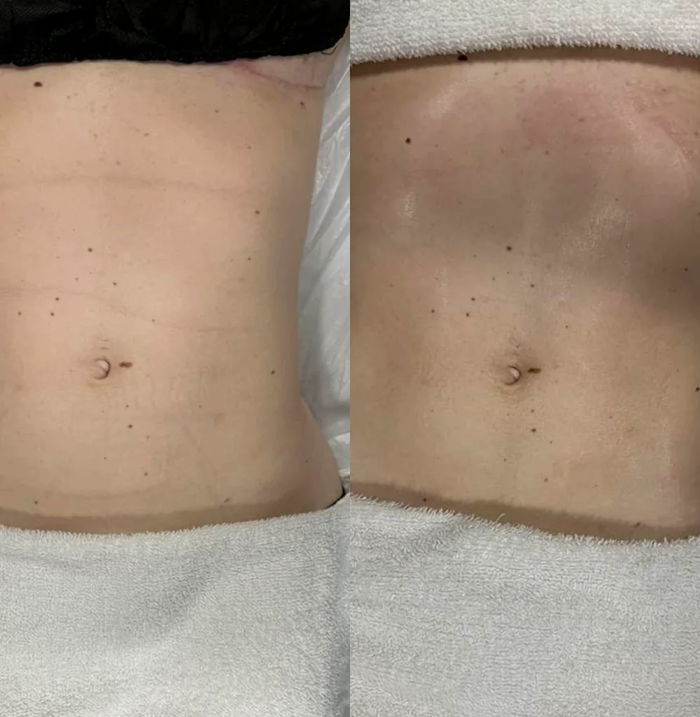 Antes e depois de tratamento corporal na região abdominal