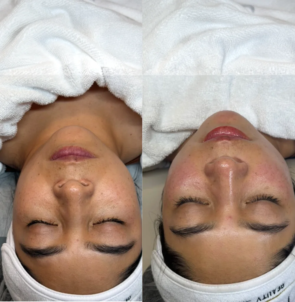 Antes e depois de Limpeza de Pele