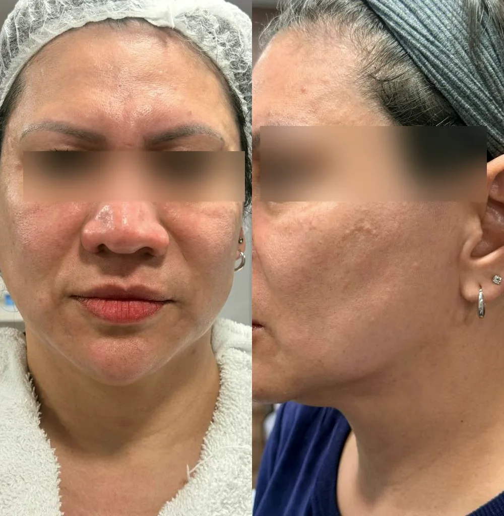 Antes e depois de tratamento para manchas e textura da pele