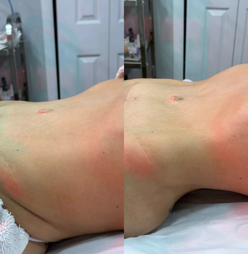 Antes e depois de drenagem linfática pós-operatória